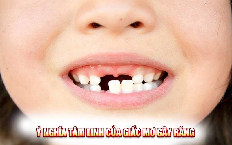 Giải Mã Giấc Mơ Gãy Răng: Sự Thật Sau Giấc Mơ Đáng Sợ Này!